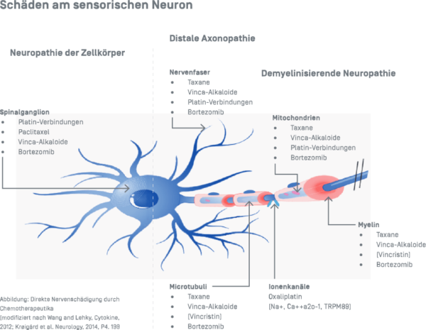 Polyneuropatie - Schäden am Sensorchen Neuron - Grafik